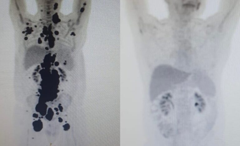 entenda-a-diferenca-entre-cura-do-cancer-e-remissao-da-doenca