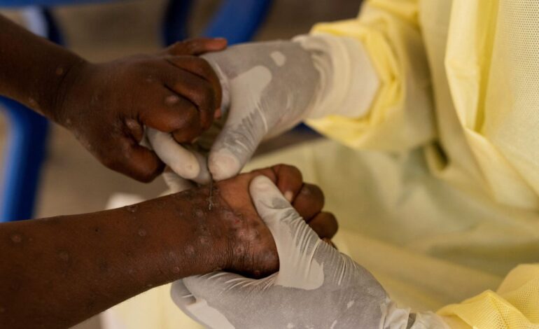 África declara emergência em saúde pública por epidemia de mpox