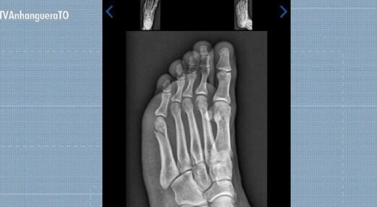 Candidato supera fratura no pé e passa em teste físico da PMTO | G1