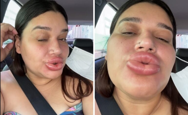 maquiadora-fica-com-labios-gigantes-apos-retirar-preenchimento-|-g1