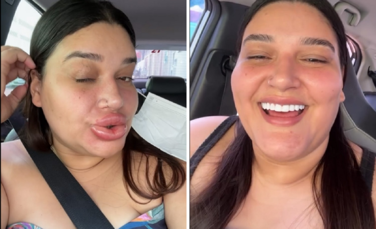 jovem-que-ficou-com-labios-gigantes-diz-que-preenchimento-deu-errado-|-g1